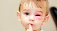 Про те, як видалити набряк після укусу комахи